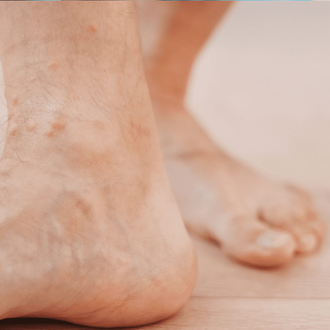 plantar fasciitis