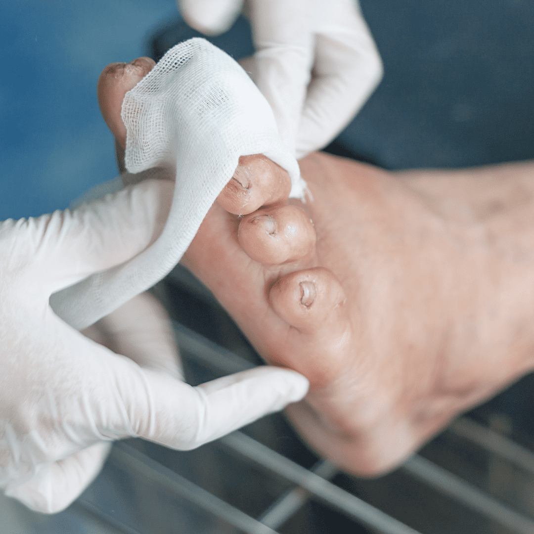plantar fasciitis