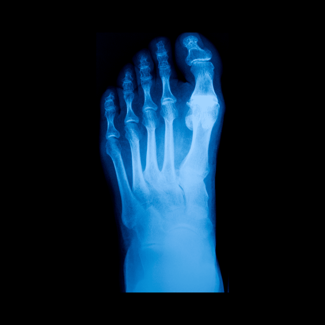 diabetic foot care