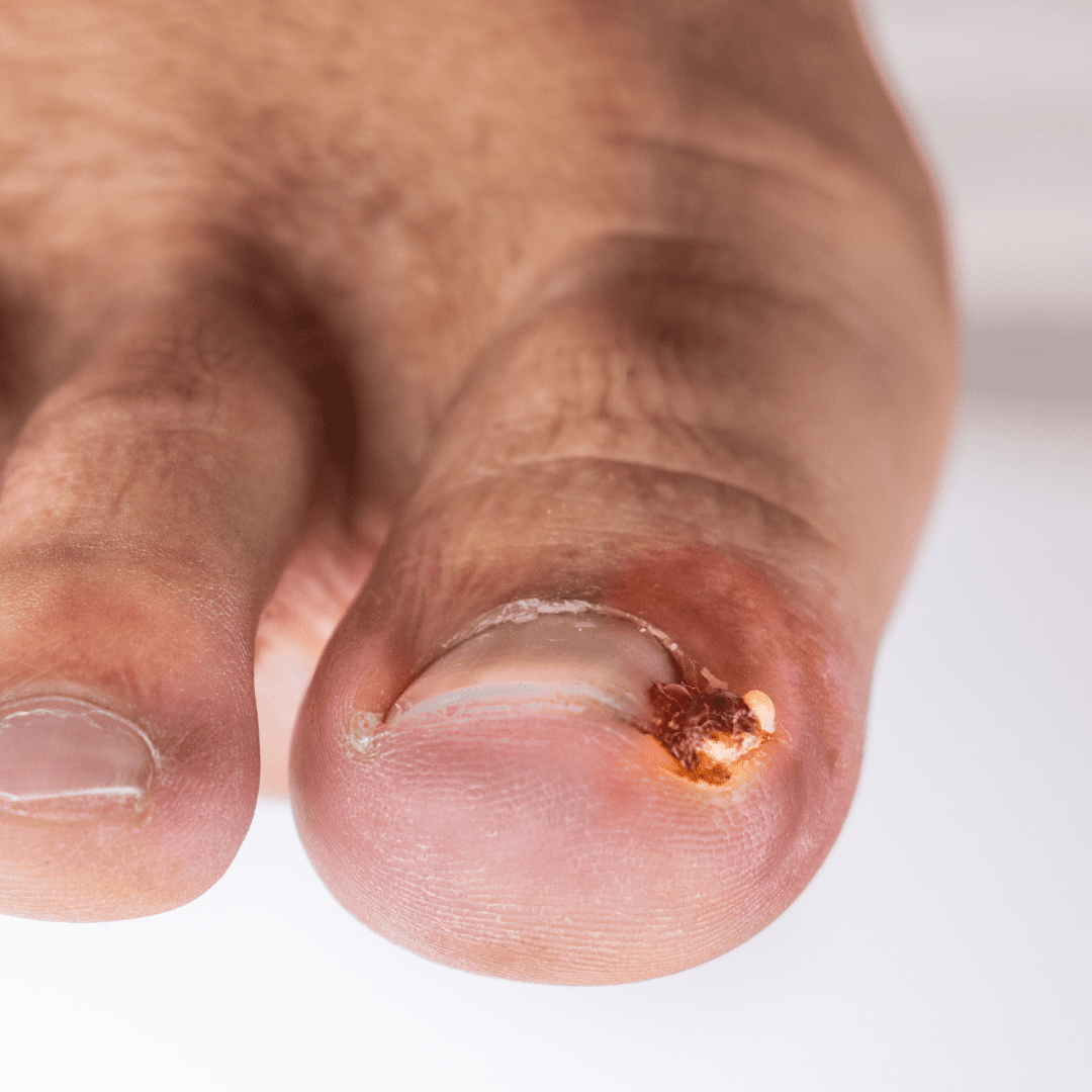 plantar fasciitis guide
