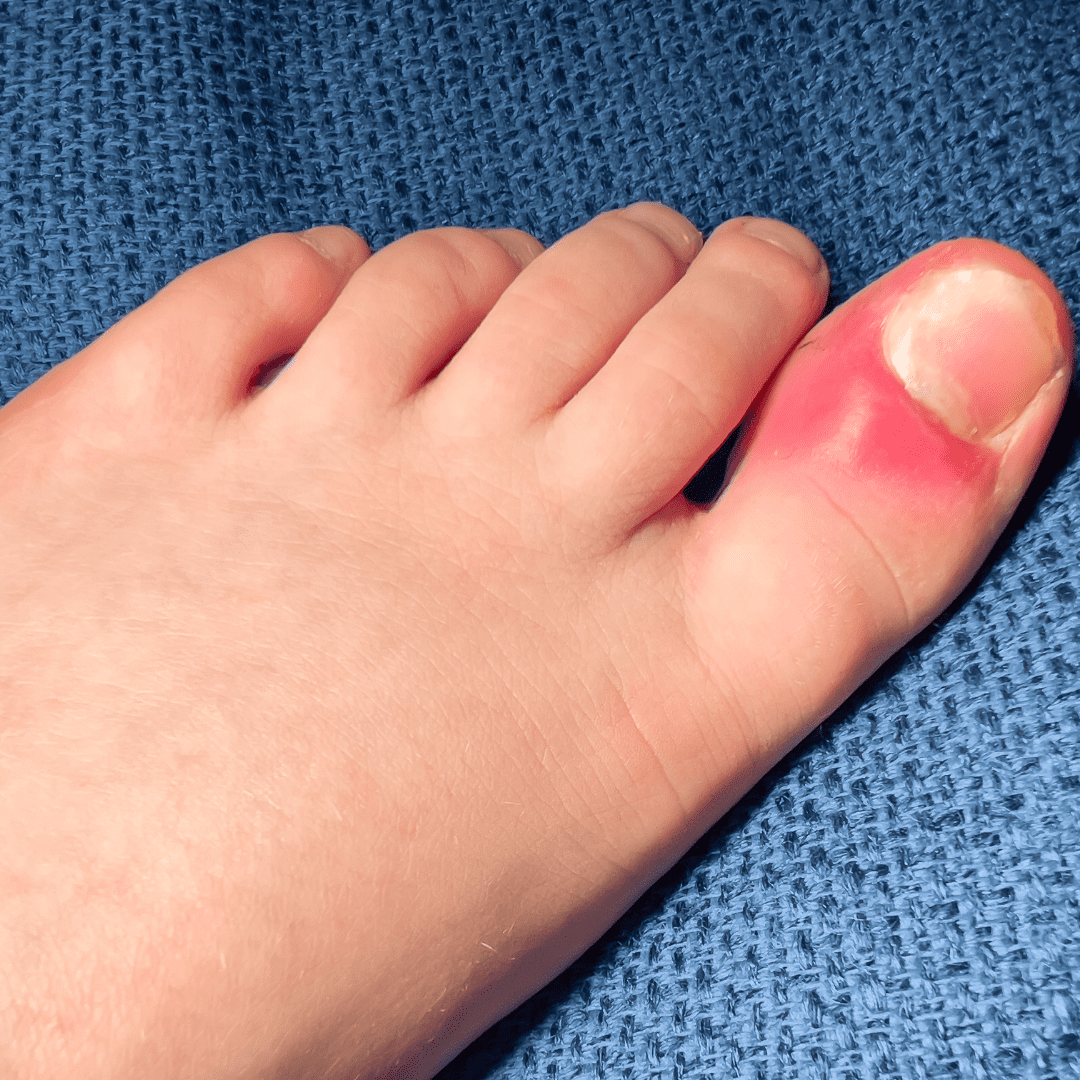 plantar fasciitis flare up