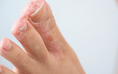 why athlete’s foot keeps coming back and how to finally stop it
