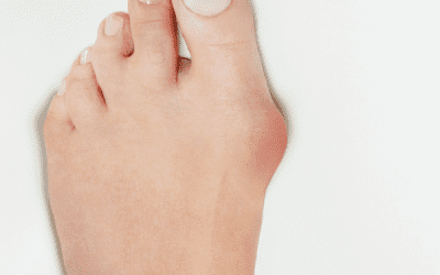 when should you have bunion surgery? why “wait until it’s unbearable” is outdated advice